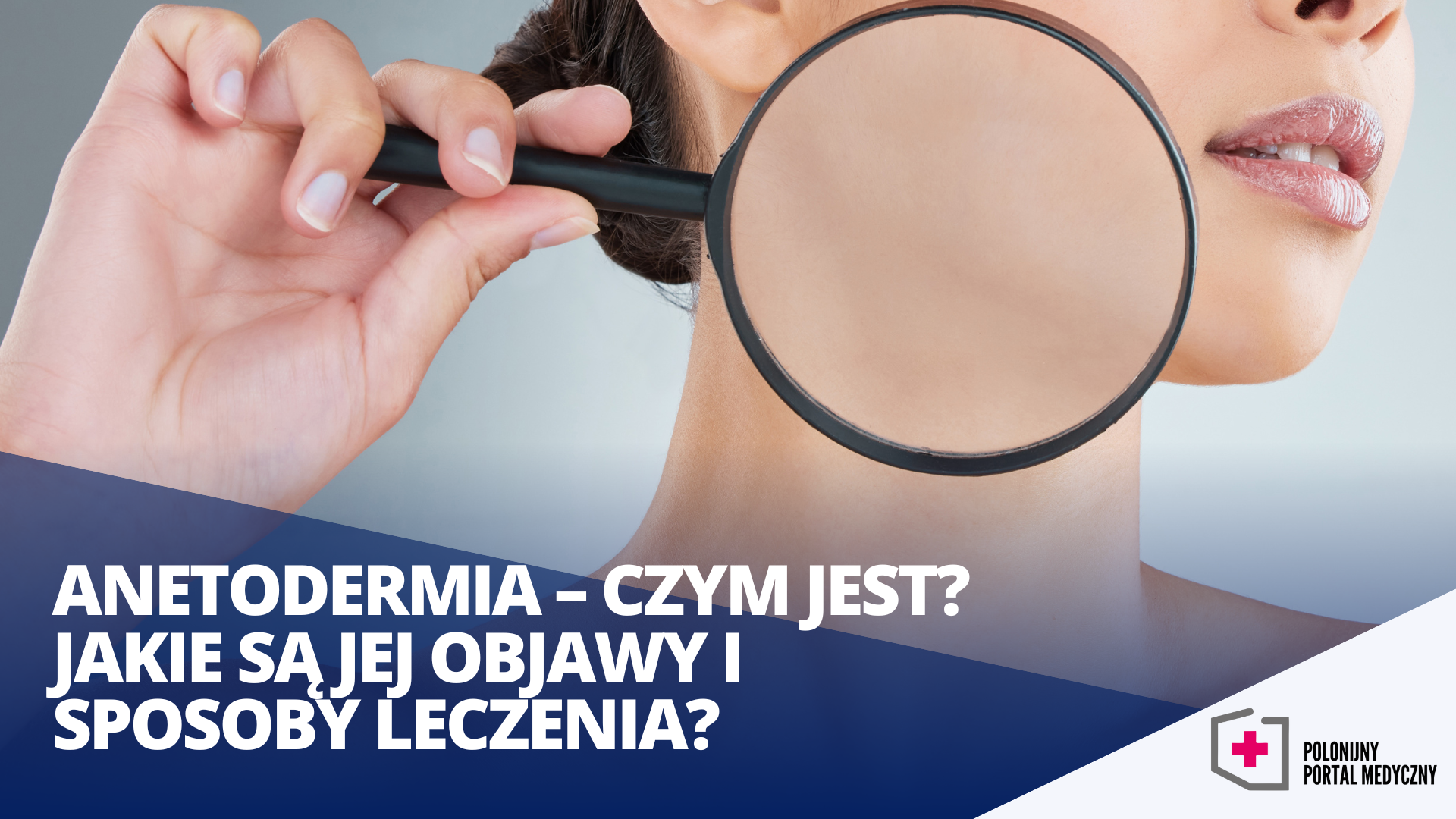 Anetoderma Face Anetodermia – czym jest? Jakie są jej objawy i sposoby leczenia ...